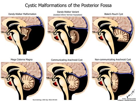 mega cisterna magna versus arachnoid cyst|Management of Arachnoid Cysts: A Comprehensive Review.